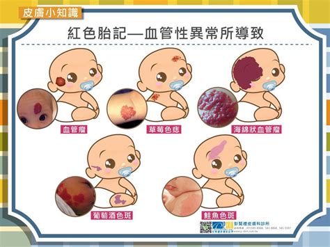 嬰兒血管瘤胎記|嬰兒血管瘤會消失嗎？一篇搞懂嬰兒血管瘤的原因、種。